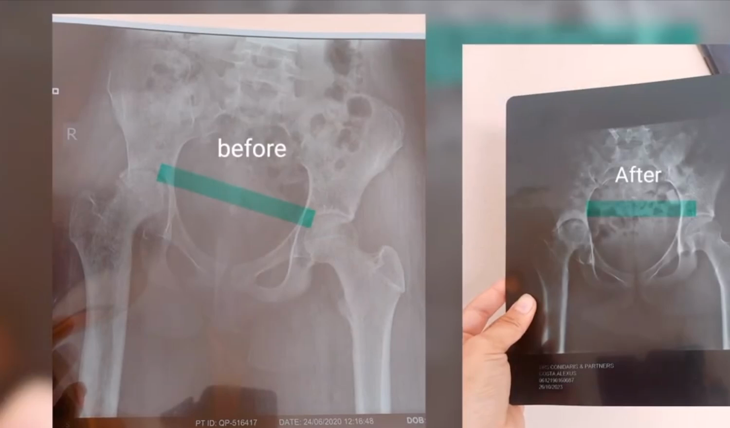 Before and after X-rays of a hip held up side by side